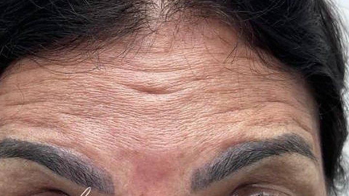 Testa antes da toxina botulínica
