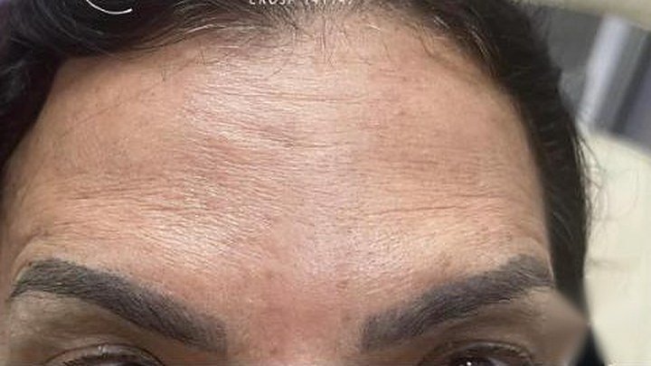 Testa depois da toxina botulínica