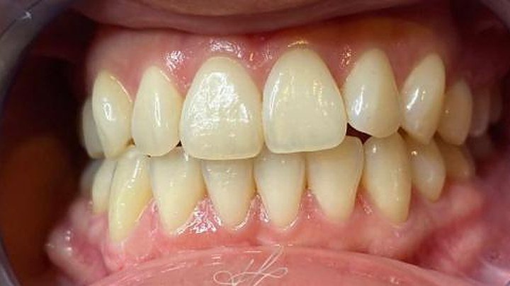 Dentes antes do clareamento