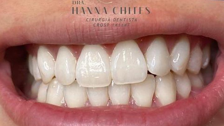 Dentes depois do clareamento