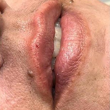 Lábios pós imediato de preenchimento labial